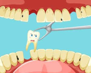 Dent provisoire après extraction : Guide complet 