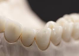 prothèse dentaire pmma
