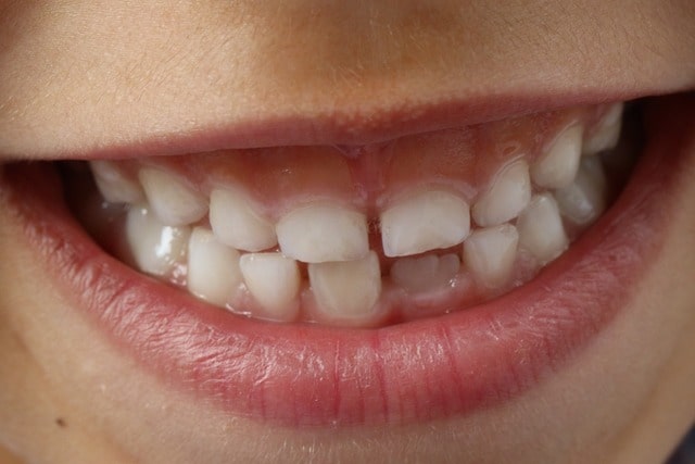 Dentition : tout ce que vous devez savoir