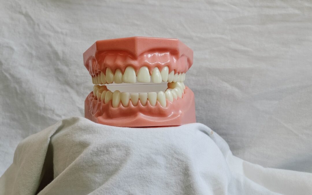 Bridge dentaire : solution pour remplacer plusieurs dents absentes