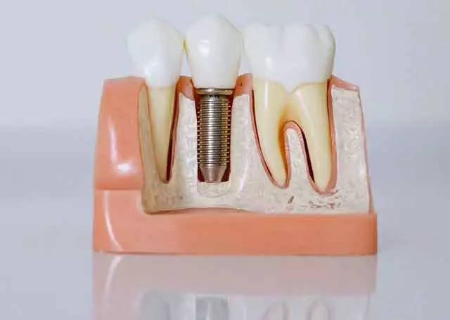 implant dentaire : moule implant