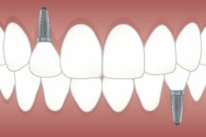 prix implant basal