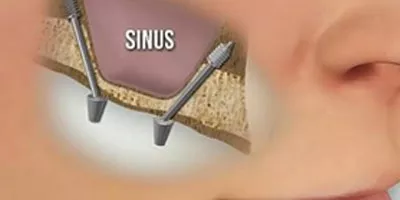 implant basal sinus