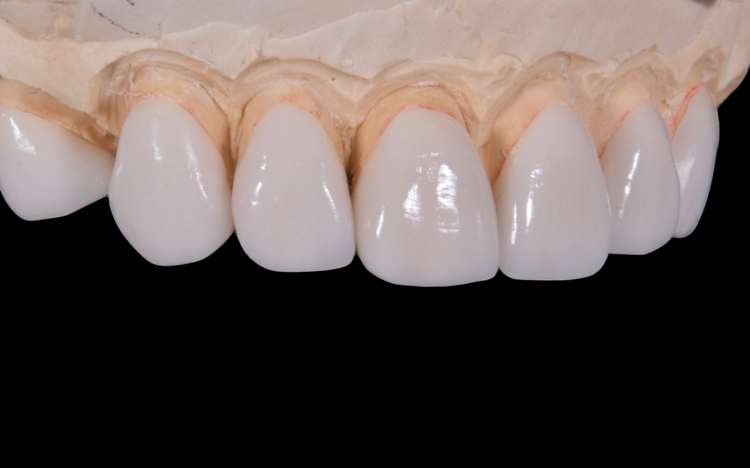 Dents provisoires : à quoi servent-elles ?