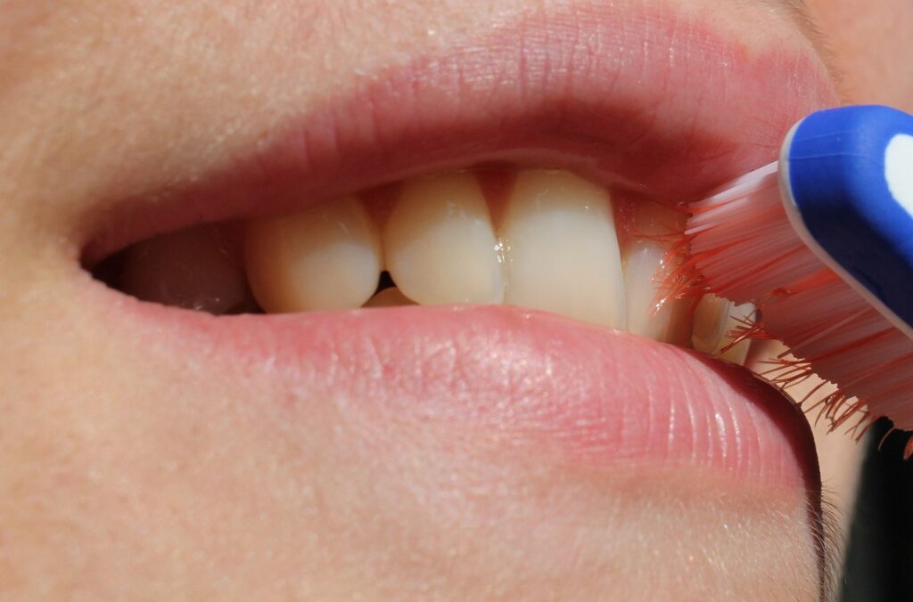 Blanchiment dentaire ou facettes dentaires