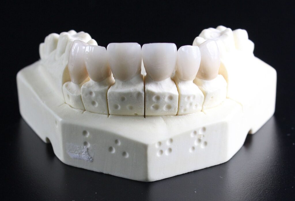 Implant dentaire ou dentier
