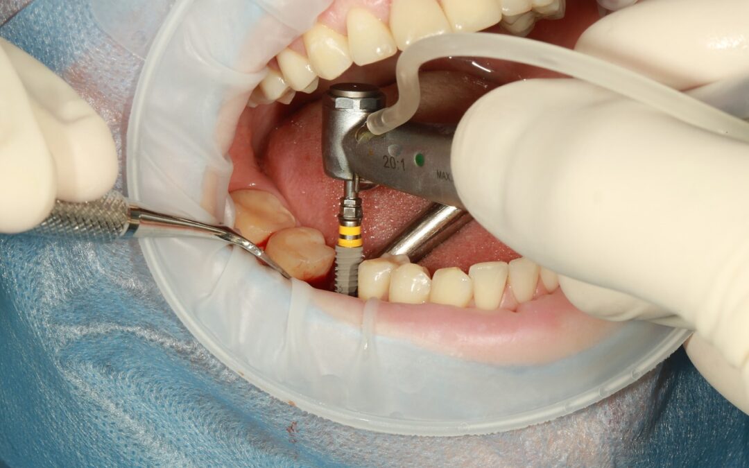 Choix crucial : implant dentaire ou prothèse dentaire amovible ?