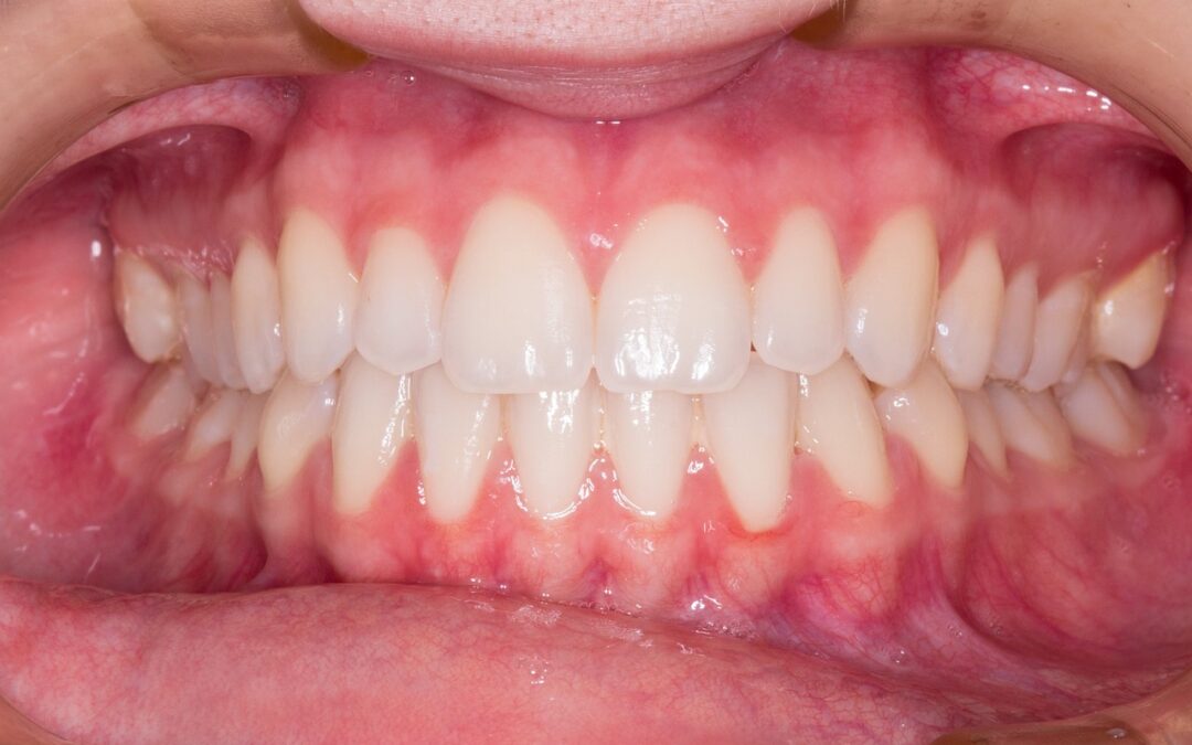 Réhabilitation dentaire complète
