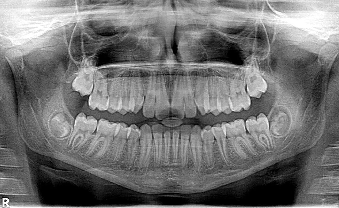 Dangers d’une radiographie dentaire – Découvrez les risques et les précautions