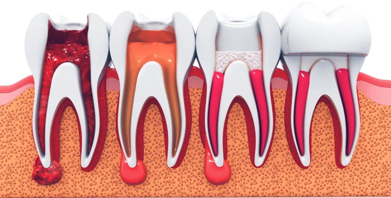 Infection d'une dent dévitalisée Guide complet des solutions dentaires 2024