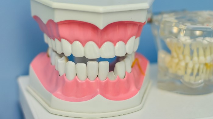 Gencive qui recule ? Guide complet pour comprendre et traiter la récession gingivale