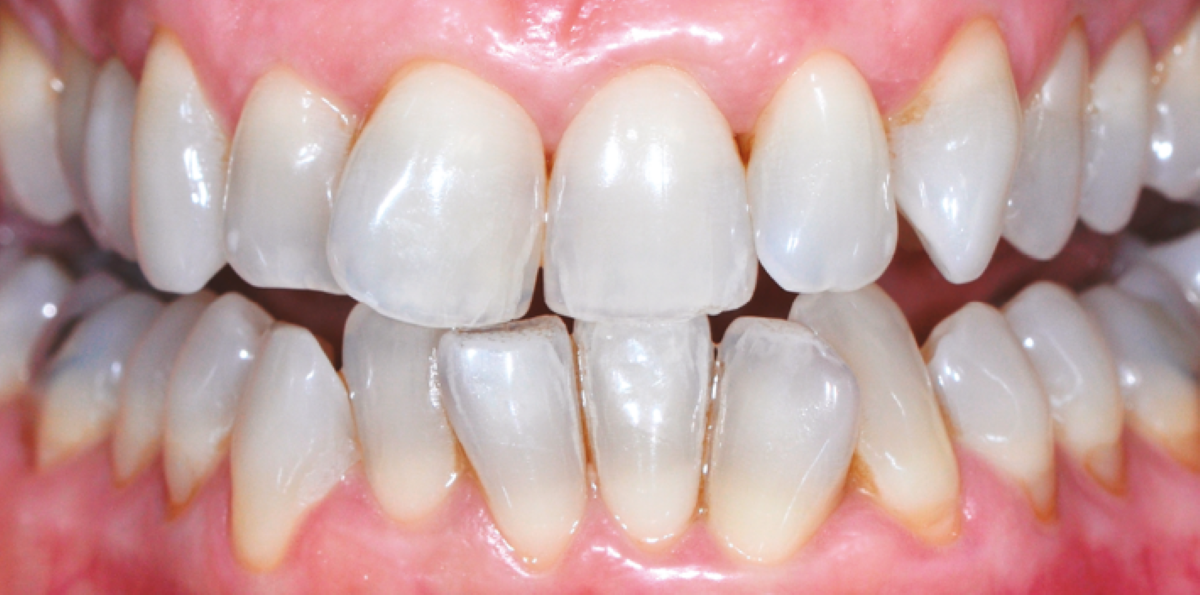 Dents qui deviennent transparentes causes et solutions — free download