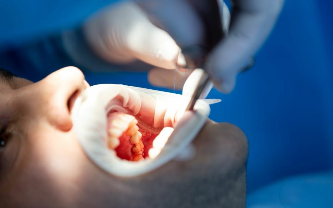 Alvéolite Dentaire | guide complet 2025 par France Dental Clinique
