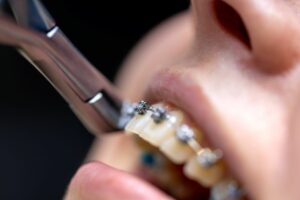 Bagues dentaires céramiques ou métalliques Guide complet pour choisir 