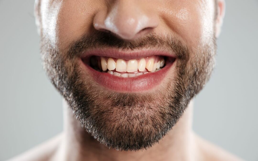 Taches blanches dents sur les dents qui apparaissent: traitement| France Dental