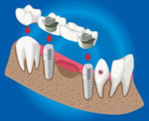 Vis d’implant dentaire tombé ? Guide urgent