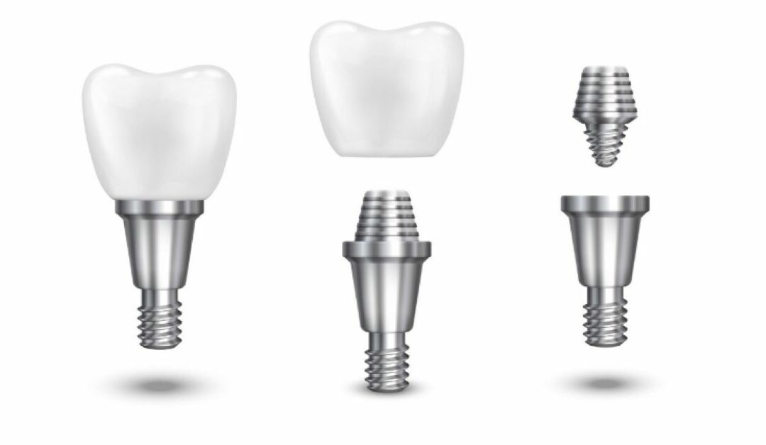 Vis d'implant dentaire tombé ? Guide urgent des solutions par nos experts
