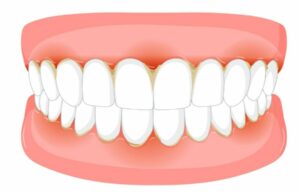 Dents Trop Serrées Que Faire ? Solutions Experts