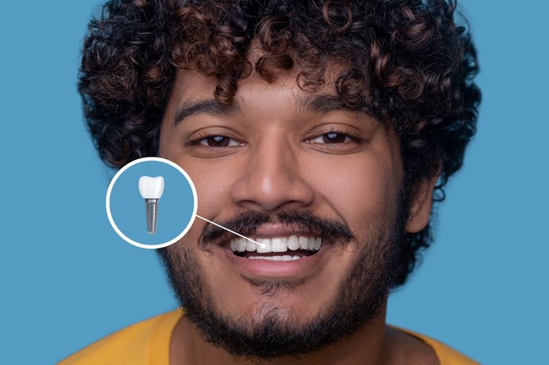 remplacer une dent sans implant