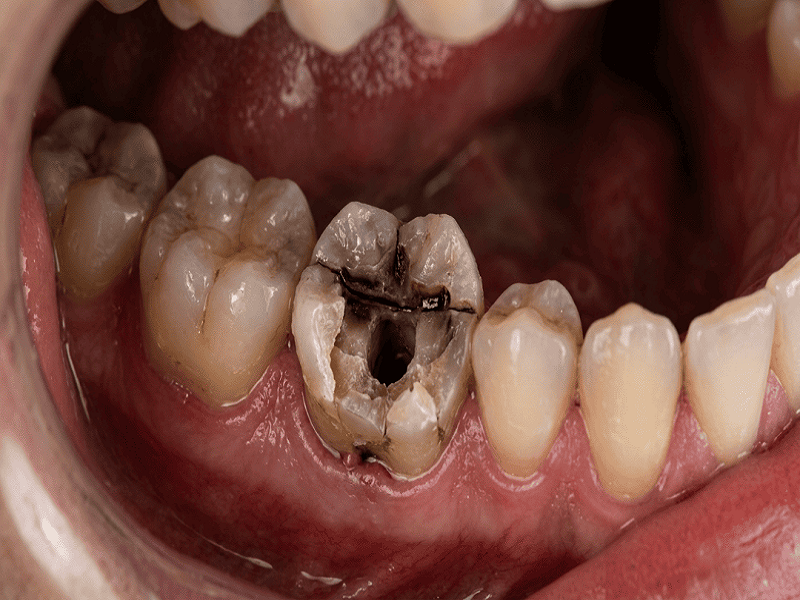 Peut-on rester longtemps sans couronne dentaire ? Risques et solutions